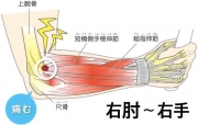 外側上顆炎のイラストです