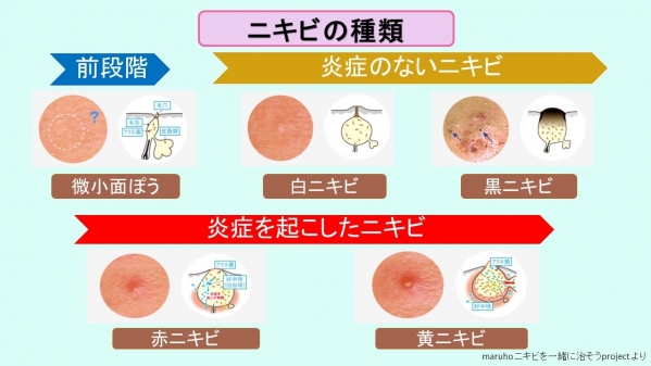 横浜市金沢区六浦皮ふ科 ニキビの種類