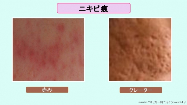 横浜市金沢区六浦皮ふ科 ニキビ痕