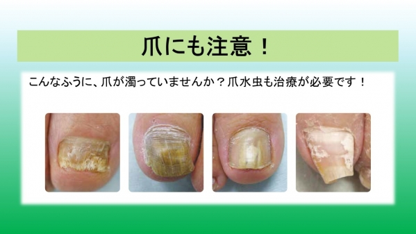 横浜市金沢区六浦皮ふ科 爪白癬